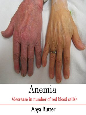 cover image of Anemia